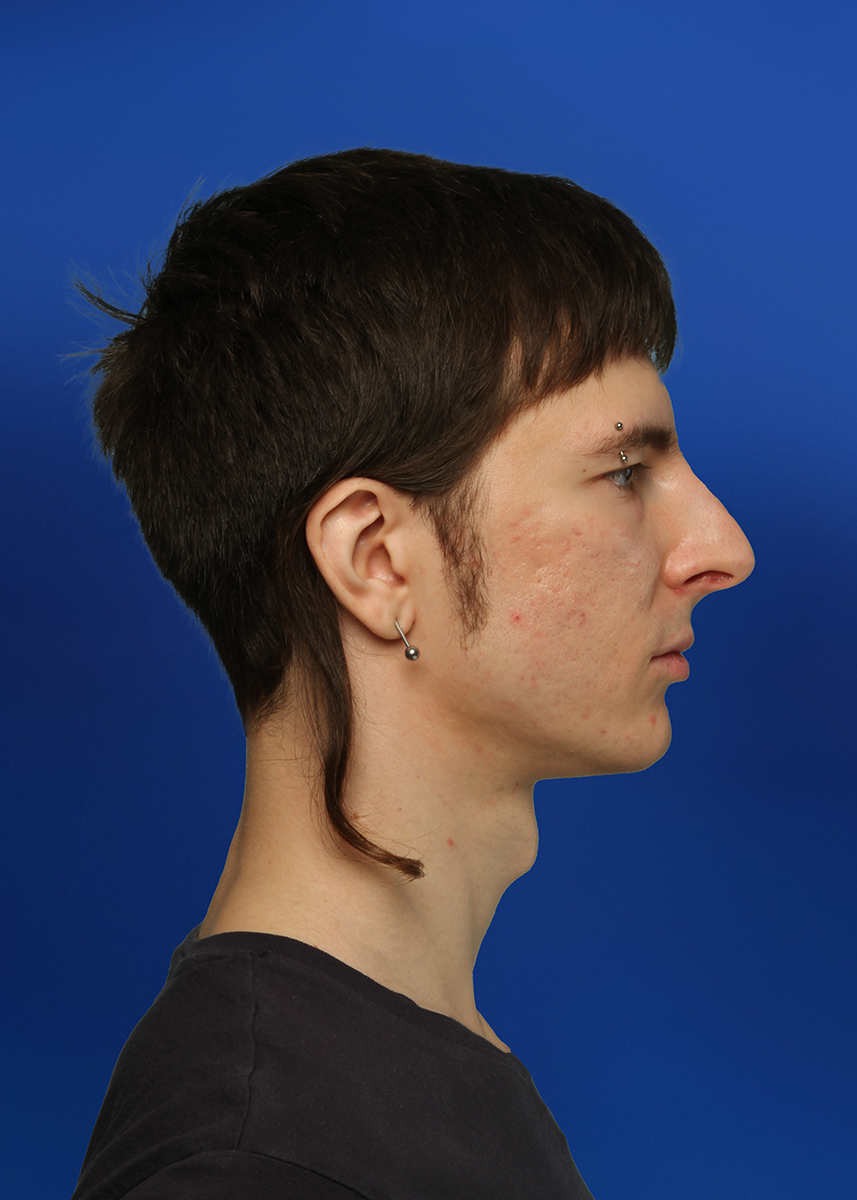 Before Rhinoplasty - Front View